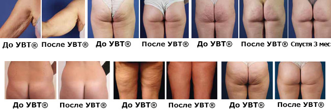 Ударно-волновая терапия целлюлит Ударно-волновая терапия целлюлит